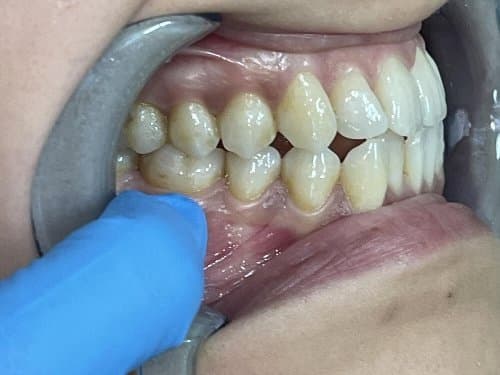 Image before and after treatment