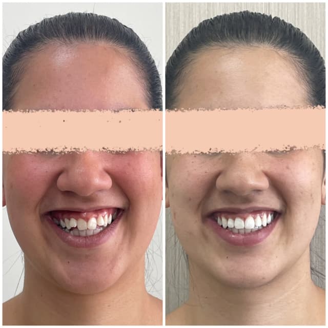 Image before and after treatment