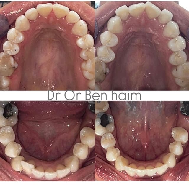 Image before and after treatment